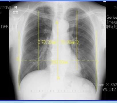 カ心胸郭比測定